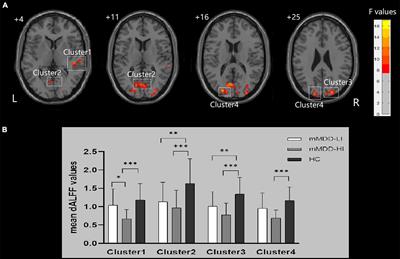 The aberrant dynamic amplitude of low-frequency fluctuations in melancholic major depressive disorder with insomnia